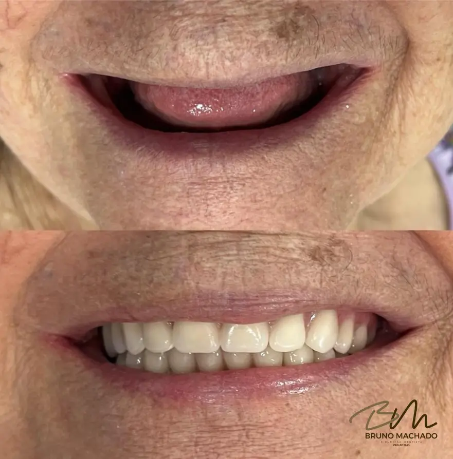 Prótese Protoco sobre Implantes!