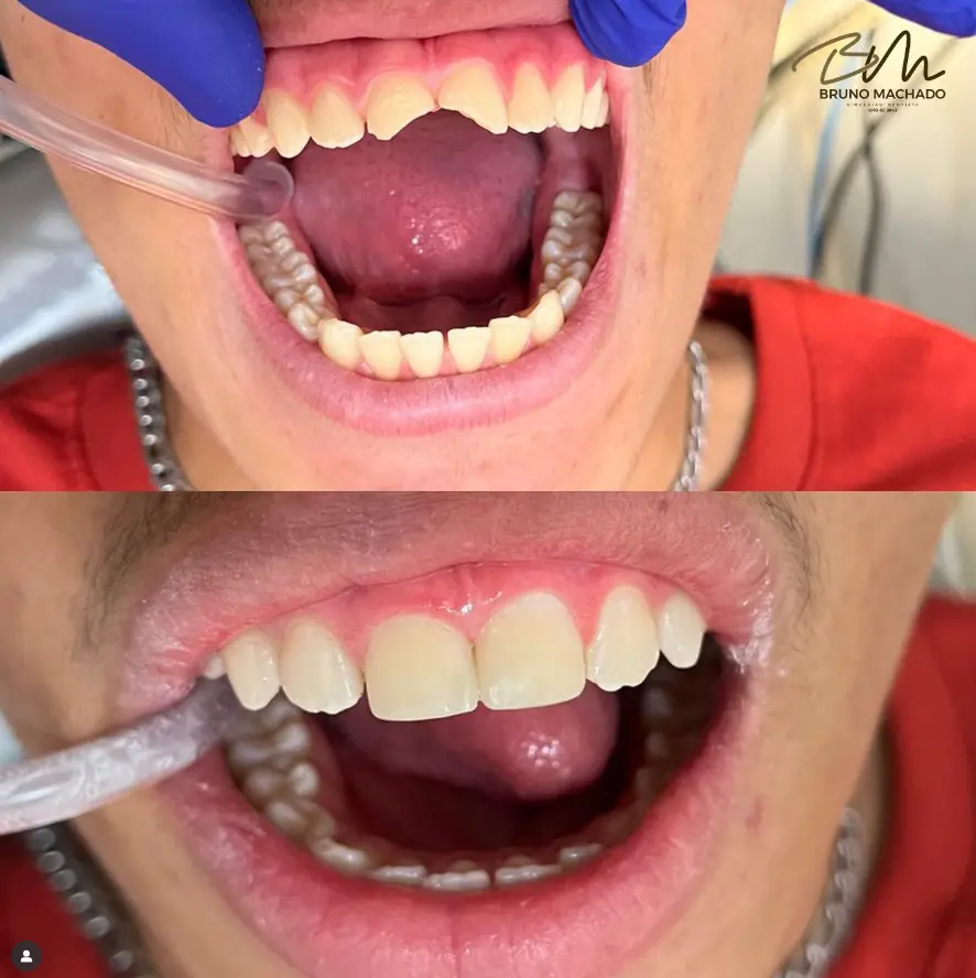 procedimento de restauração